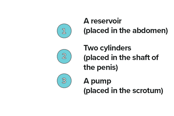 Explanation-of-the-Inflatable-Penile-Implant-component