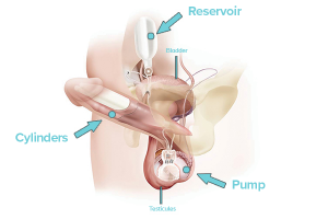 Inflatable Penile Implant illustration of the component schema